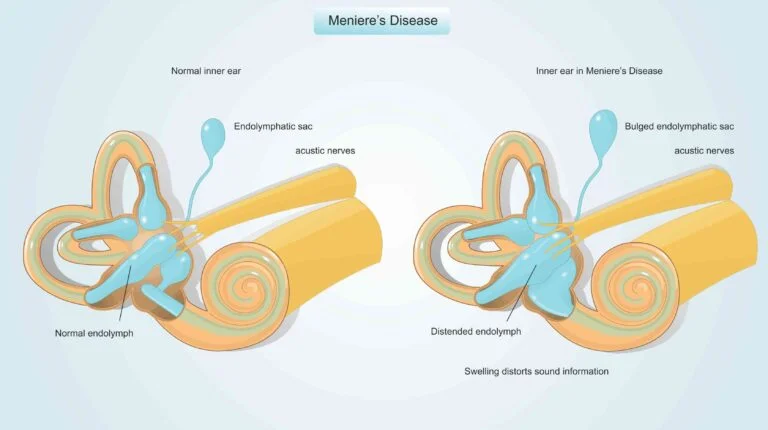 Ear anatomy diagram of Meniere's disease and healthy ear